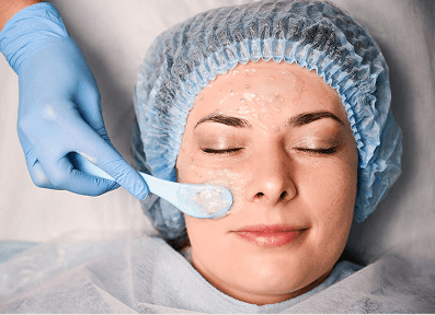 Chemical Peel