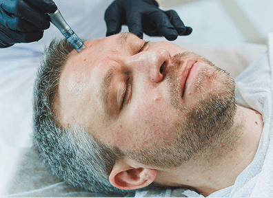 Micro-Needling